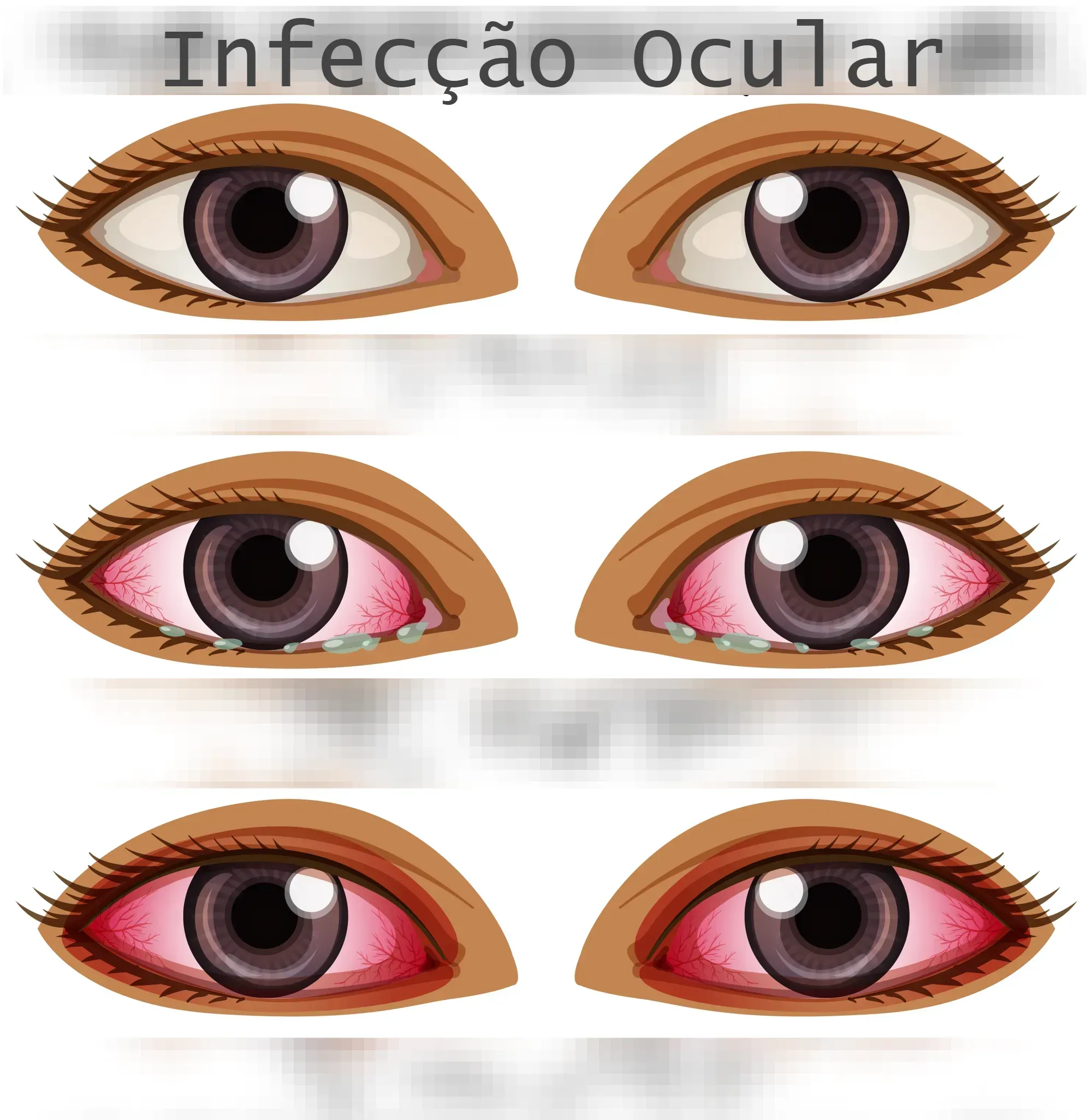 Infecção Ocular