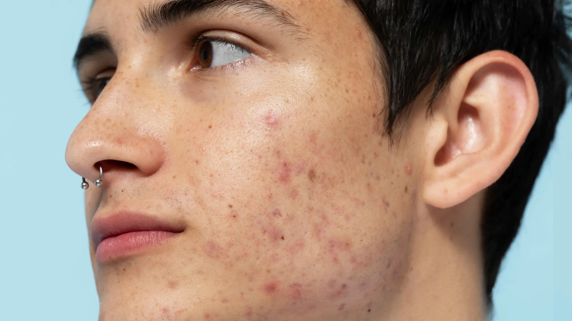 Pessoa com acne